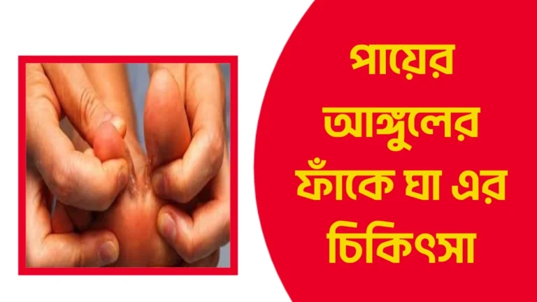 পায়ের আঙ্গুলের ফাঁকে ঘা এর চিকিৎসা