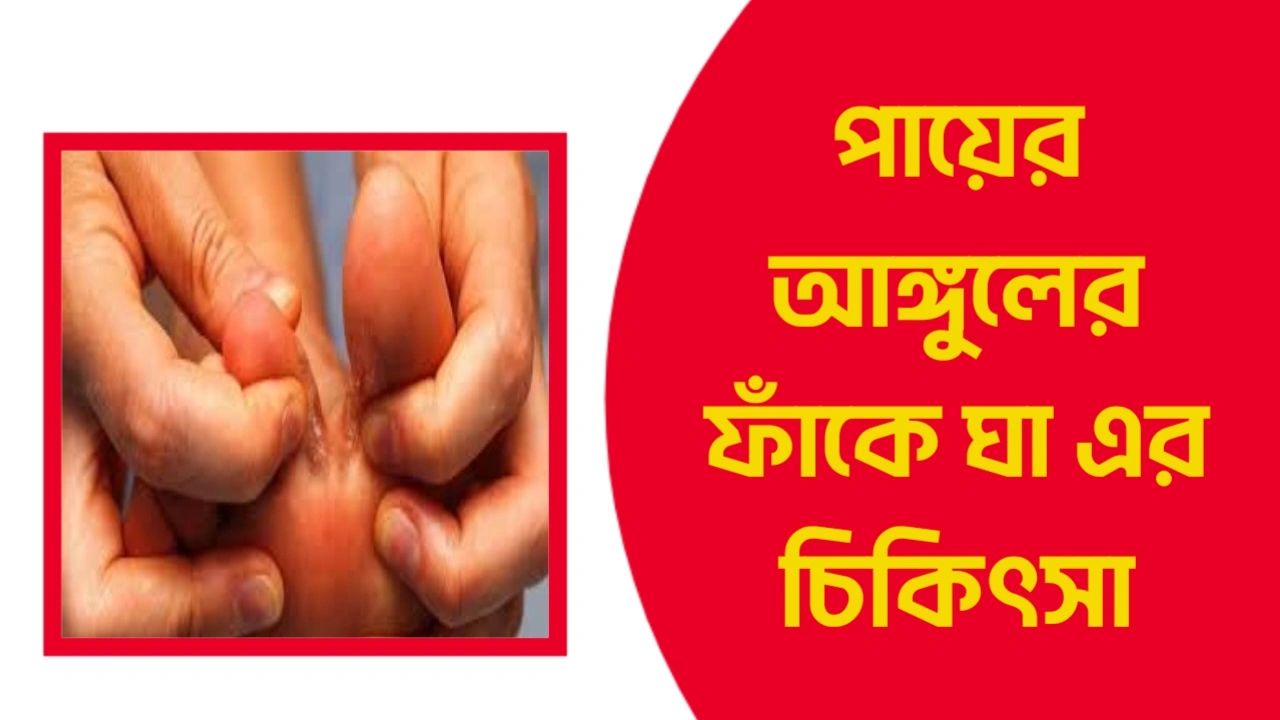 পায়ের আঙ্গুলের ফাঁকে ঘা এর চিকিৎসা